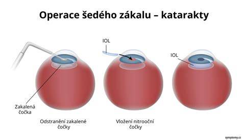 zrakova operace katarakta postup