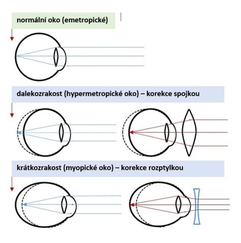 Obrázek ukazující srovnání barevné dioptrické čočky a oka