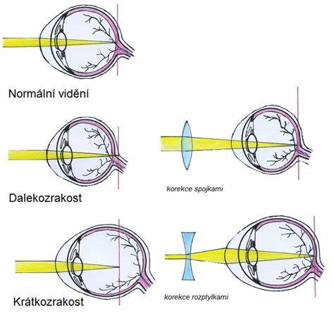 schematicke_zobrazeni_oka_a_dioptricka_korekce