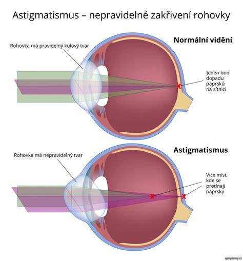 astigmatismus korekce a způsobilost