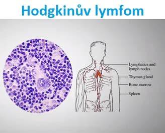 mikroskopie RS buňky Hodgkinova lymfomu