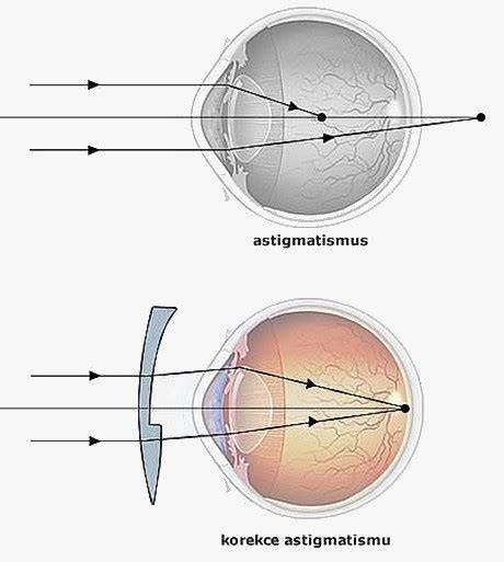 korekce astigmatismu infografika